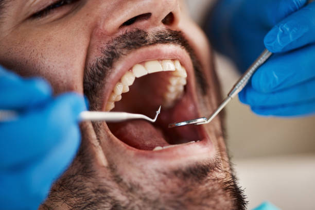 Best Emergency Dental Care for Broken or Chipped Teeth in Webster, TX